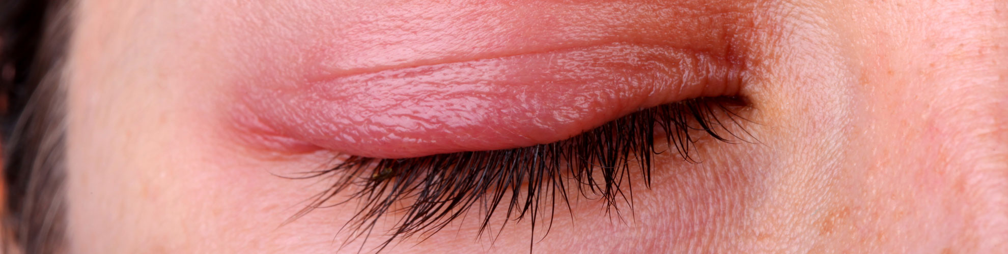 Blepharitis - SkyVision Centers