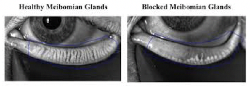 mgd meibomian gland disease